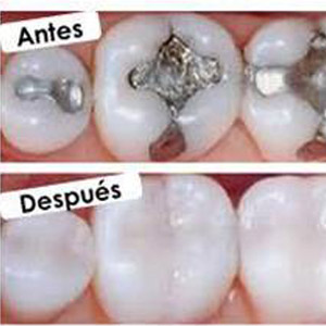 Ionómeros de vidrio