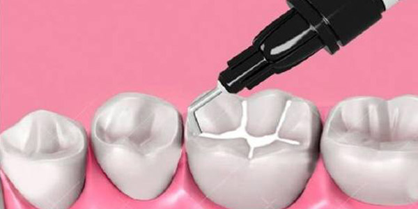 Selladores y fosfatos